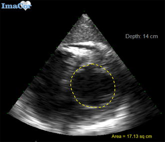 The relationship between single and two-dimensional indices of left ventricular size using hemodynamic transesophageal echocardiography in trauma and burn patients.