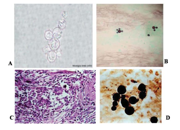 Paracoccidioidomycosis: Current Perspectives from Brazil.