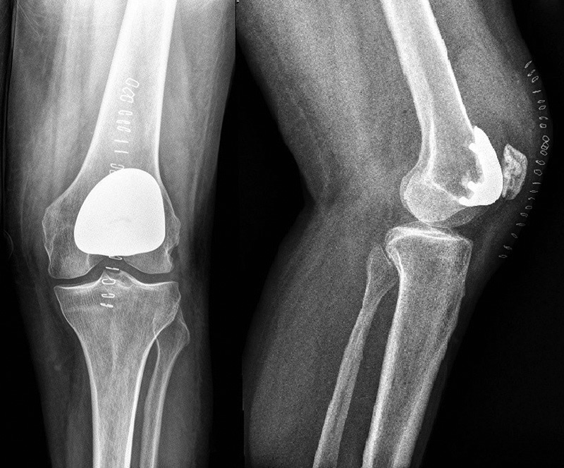 Patellofemoral Arthroplasty: Current Concepts and Review of the Literature.