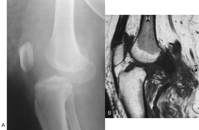 Neglected Posterior Knee Dislocation: An Unusual Case Report.