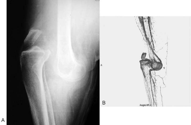 Neglected Posterior Knee Dislocation: An Unusual Case Report.