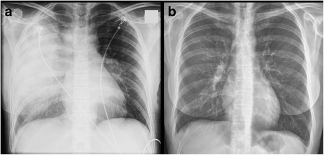 Case report on a defective antibody response against pneumococcal serotype 9V in a patient with a single episode of pneumonia.