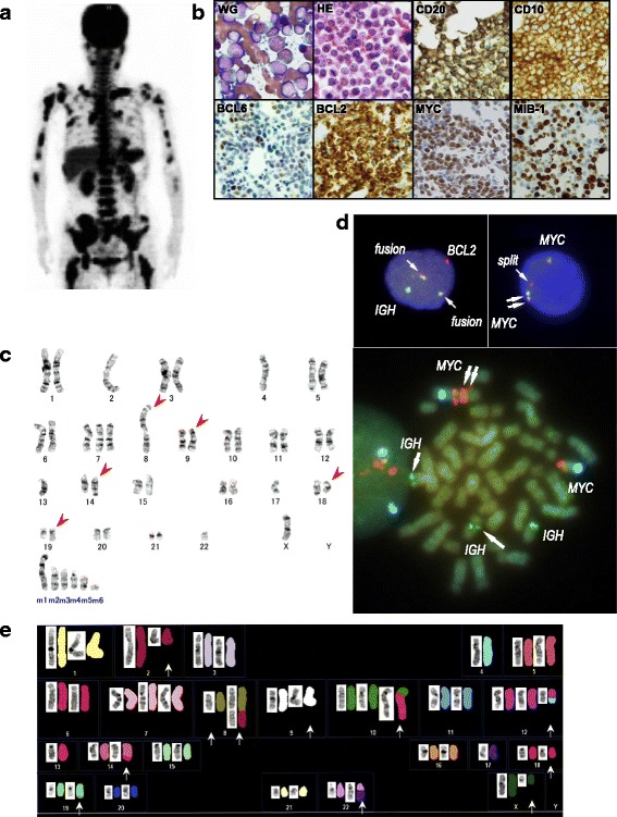 De novo acute lymphoblastic leukemia-like disease of high grade B-cell lymphoma with <i>MYC</i> and <i>BCL2</i> and/or <i>BCL6</i> rearrangements: a case report and literature review.