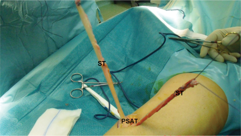 Clinical Outcomes and Return to Sports in Patients with Chronic Achilles Tendon Rupture after Minimally Invasive Reconstruction with Semitendinosus Tendon Graft Transfer.