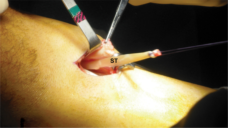 Clinical Outcomes and Return to Sports in Patients with Chronic Achilles Tendon Rupture after Minimally Invasive Reconstruction with Semitendinosus Tendon Graft Transfer.