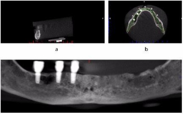 Effect of Dental Implant Metal Artifacts on Accuracy of Linear Measurements by Two Cone-Beam Computed Tomography Systems Before and After Crown Restoration.