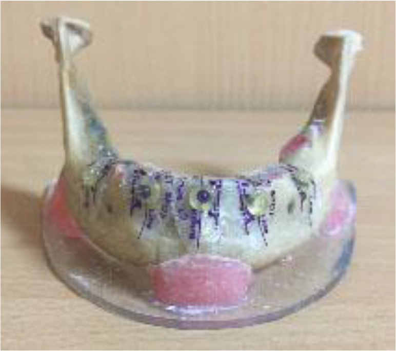 Effect of Dental Implant Metal Artifacts on Accuracy of Linear Measurements by Two Cone-Beam Computed Tomography Systems Before and After Crown Restoration.