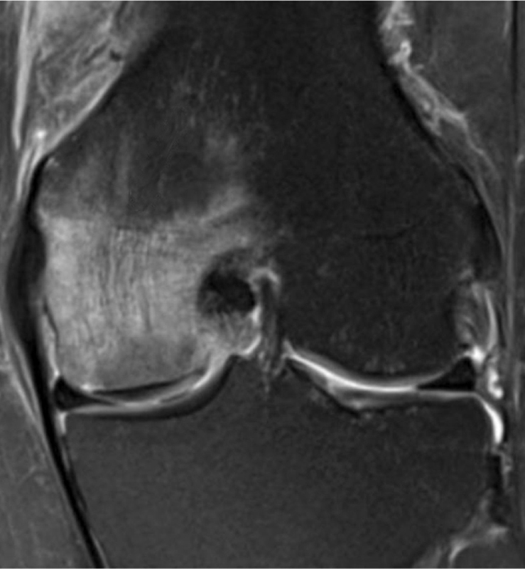 Postarthroscopy Osteonecrosis of the Knee: Current Concepts.