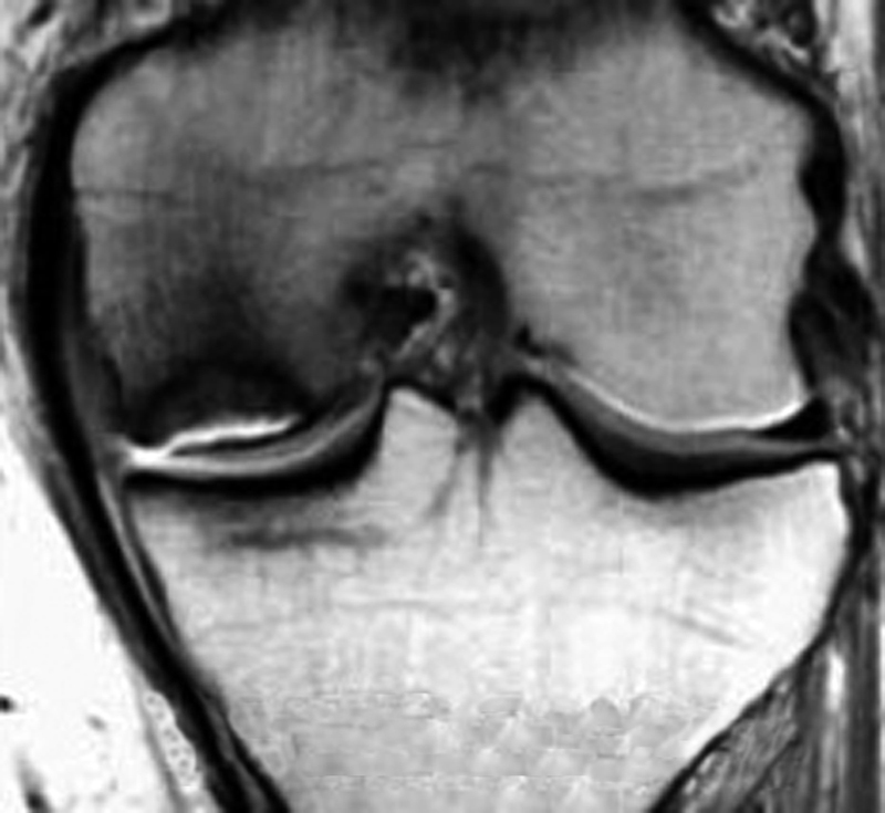 Postarthroscopy Osteonecrosis of the Knee: Current Concepts.