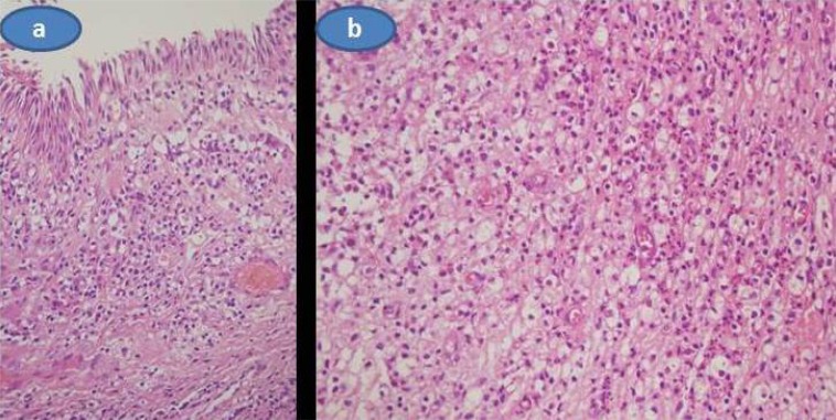 Unilateral Adult Xanthogranulomatous Infiltration of the Conjunctiva, Limbus and Sclera Leading to a Combined Ophthalmic Artery and Central Retinal Vein Occlusion.