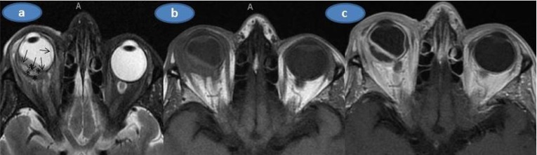 Unilateral Adult Xanthogranulomatous Infiltration of the Conjunctiva, Limbus and Sclera Leading to a Combined Ophthalmic Artery and Central Retinal Vein Occlusion.