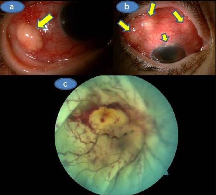 Unilateral Adult Xanthogranulomatous Infiltration of the Conjunctiva, Limbus and Sclera Leading to a Combined Ophthalmic Artery and Central Retinal Vein Occlusion.