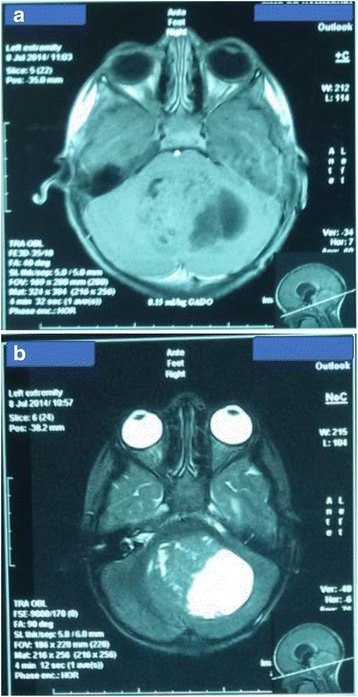 Posterior cerebral fossa medulloepithelioma: report of a case.