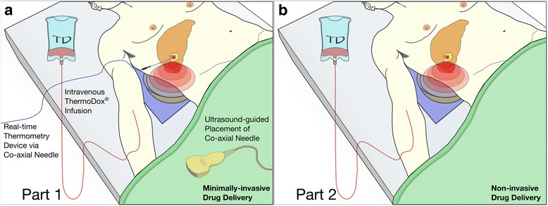 Clinical trial protocol for TARDOX: a phase I study to investigate the feasibility of targeted release of lyso-thermosensitive liposomal doxorubicin (ThermoDox®) using focused ultrasound in patients with liver tumours.