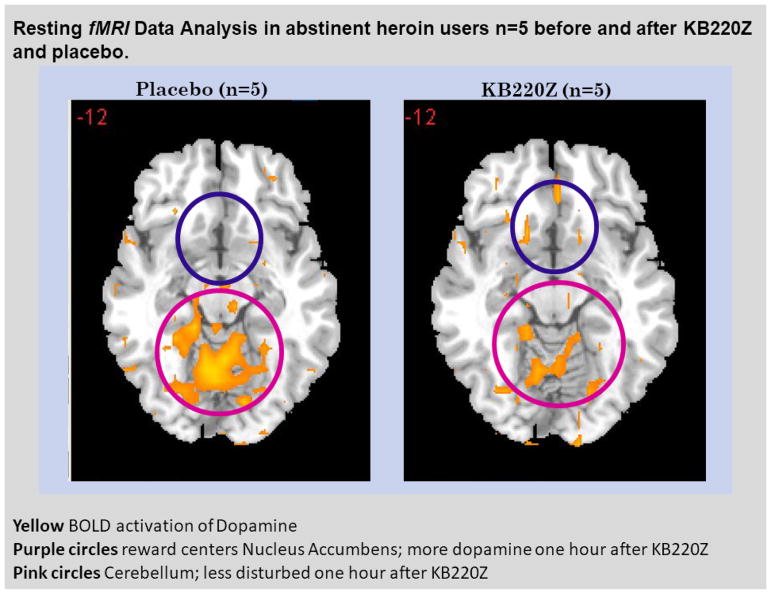 "Dopamine homeostasis" requires balanced polypharmacy: Issue with destructive, powerful dopamine agents to combat America's drug epidemic.