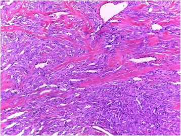 Solitary fibrous tumor occurring in the parotid gland: a case report.