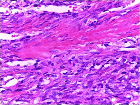 Solitary fibrous tumor occurring in the parotid gland: a case report.