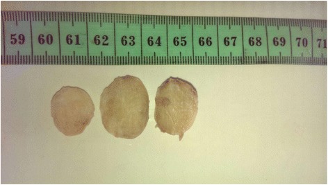 Solitary fibrous tumor occurring in the parotid gland: a case report.