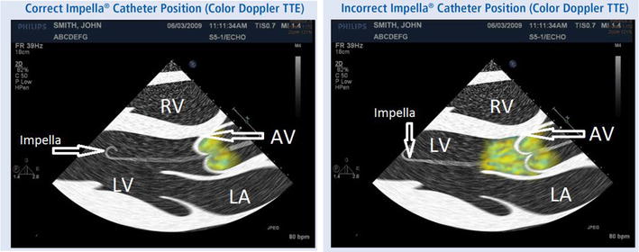 Management of cardiopulmonary assist devices in critically ill patients using point-of-care transthoracic echocardiography: a case series.