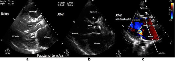 Management of cardiopulmonary assist devices in critically ill patients using point-of-care transthoracic echocardiography: a case series.