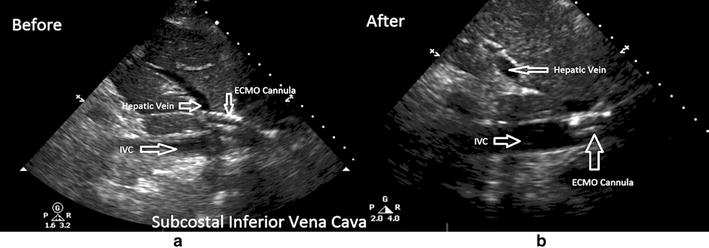 Management of cardiopulmonary assist devices in critically ill patients using point-of-care transthoracic echocardiography: a case series.