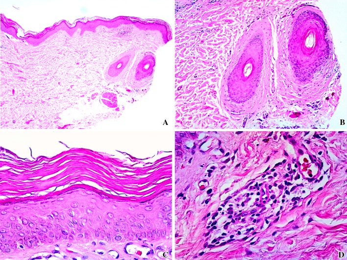 Ichthyosiform Pityriasis Rubra Pilaris-Like Eruption Secondary to Ponatinib Therapy: Case Report and Literature Review.