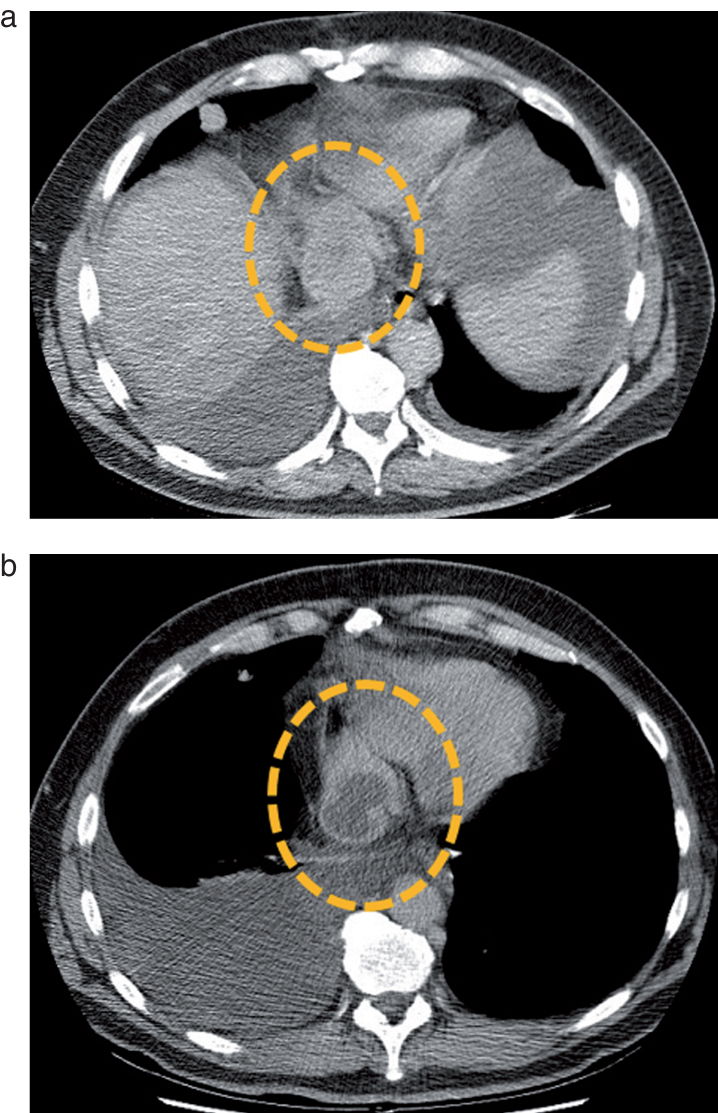 Imaging Response of Antiangiogenic and Immune-Oncology Drugs in Metastatic Renal Cell Carcinoma (mRCC): Current Status and Future Challenges.