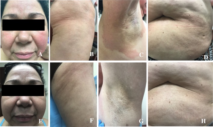 Ichthyosiform Pityriasis Rubra Pilaris-Like Eruption Secondary to Ponatinib Therapy: Case Report and Literature Review.