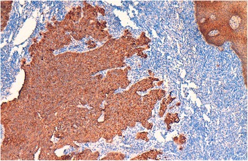 Lymphoepithelial carcinoma: a case report of a rare tumor of the larynx.