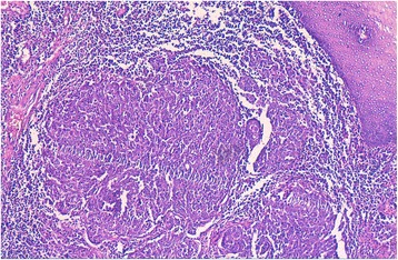 Lymphoepithelial carcinoma: a case report of a rare tumor of the larynx.