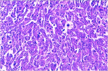 Lymphoepithelial carcinoma: a case report of a rare tumor of the larynx.