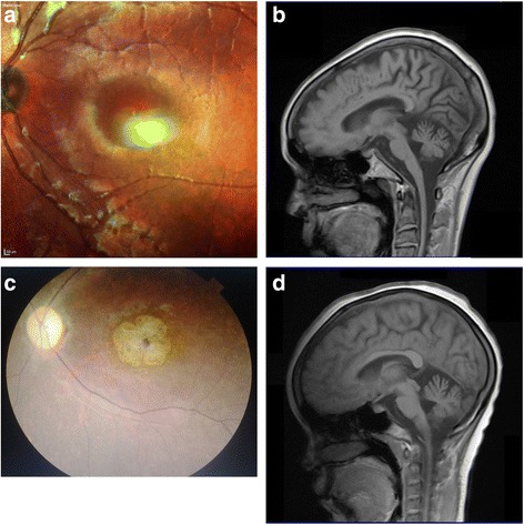 Clinical and genetic analysis of spinocerebellar ataxia type 7 (SCA7) in Zambian families.