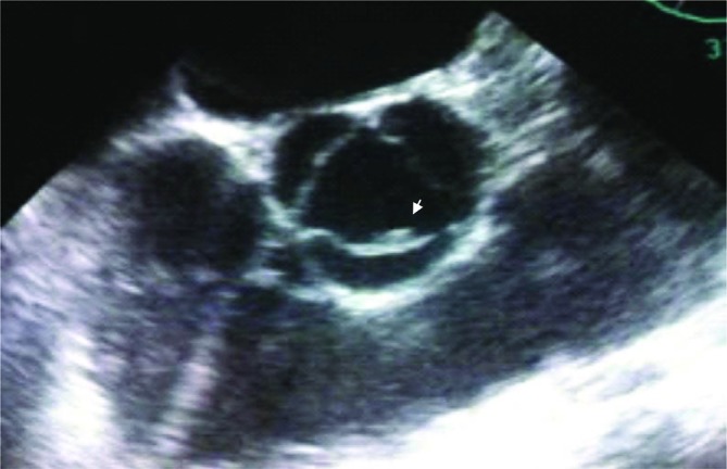 Endocarditis due to <i>Rhodotorula mucilaginosa</i> in a kidney transplanted patient: case report and review of medical literature.