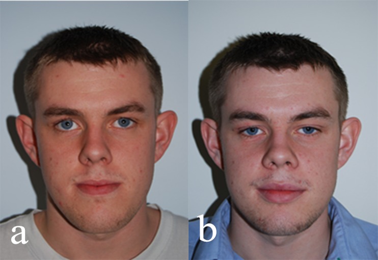 Review of nasal changes with maxillary orthognathic surgery.