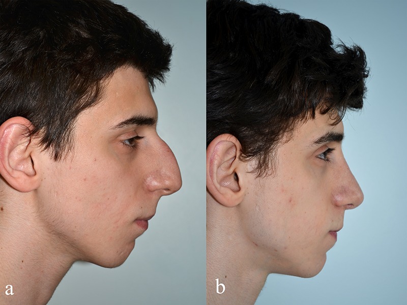 Review of nasal changes with maxillary orthognathic surgery.