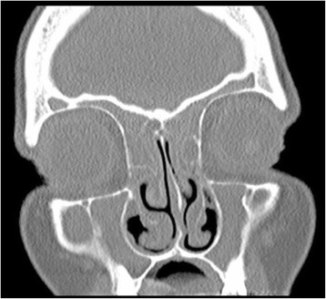 Causes of higher symptomatic airway load in patients with chronic rhinosinusitis.