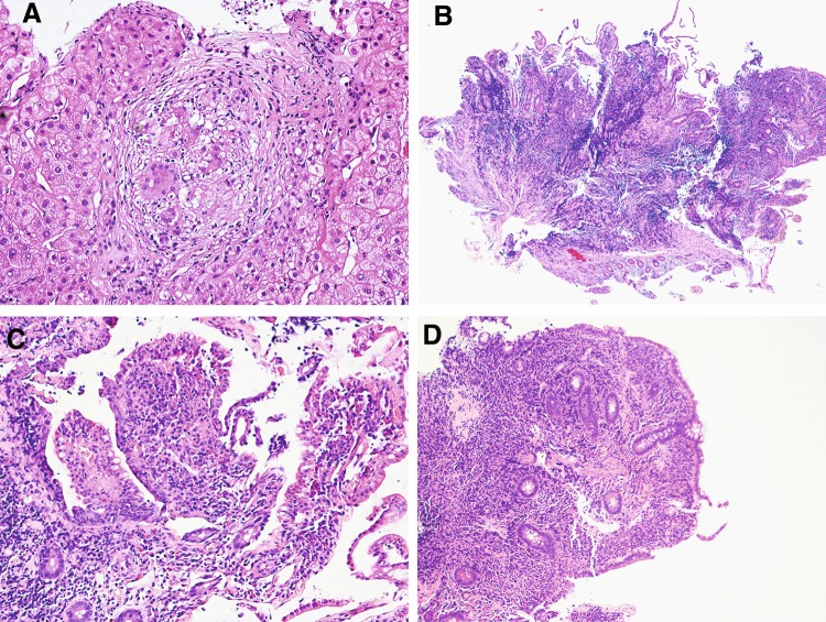 A case of sarcoidosis with isolated hepatosplenic onset and development of inflammatory bowel disease during recovery stage.