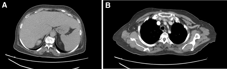 A case of sarcoidosis with isolated hepatosplenic onset and development of inflammatory bowel disease during recovery stage.