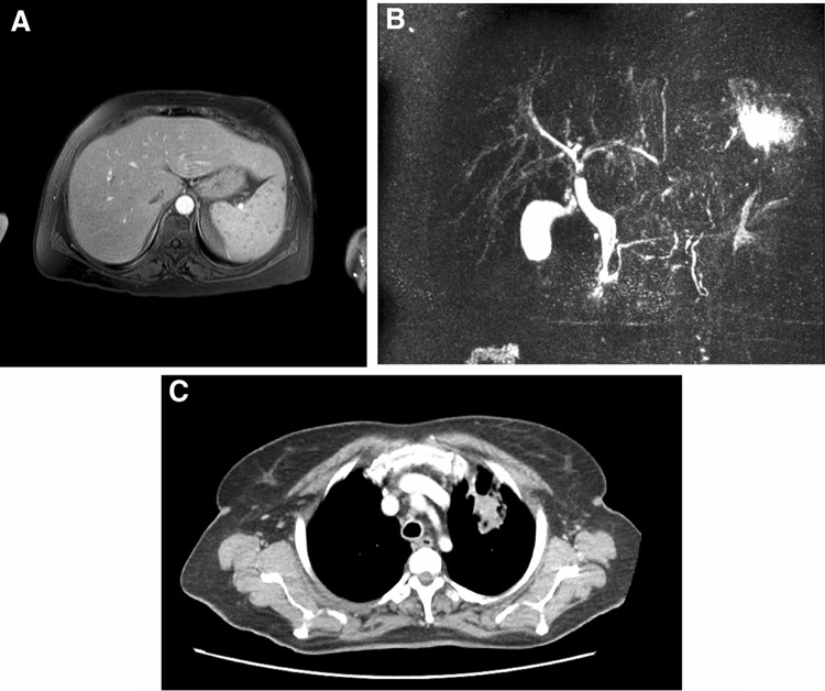 A case of sarcoidosis with isolated hepatosplenic onset and development of inflammatory bowel disease during recovery stage.