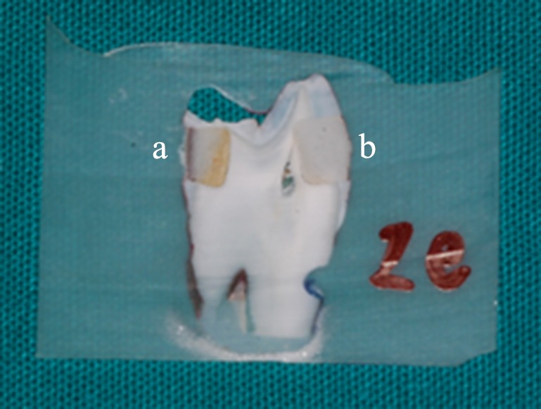 Thermo-cured glass ionomer cements in restorative dentistry.