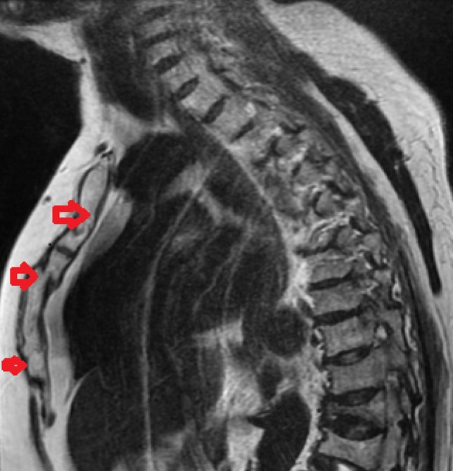 Atypical Fracture of the Sternum After Long-Term Alendronate Plus Cholecalciferol Treatment: A Case Report.