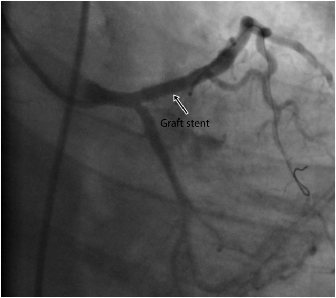 A rare complication of percutaneous coronary intervention: Coronary pseudoaneurysm formation.