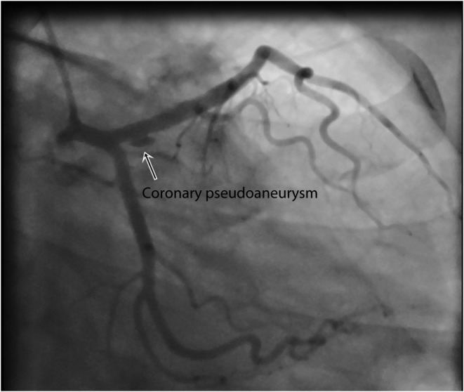 A rare complication of percutaneous coronary intervention: Coronary pseudoaneurysm formation.