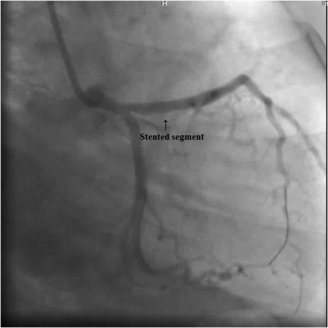 A rare complication of percutaneous coronary intervention: Coronary pseudoaneurysm formation.