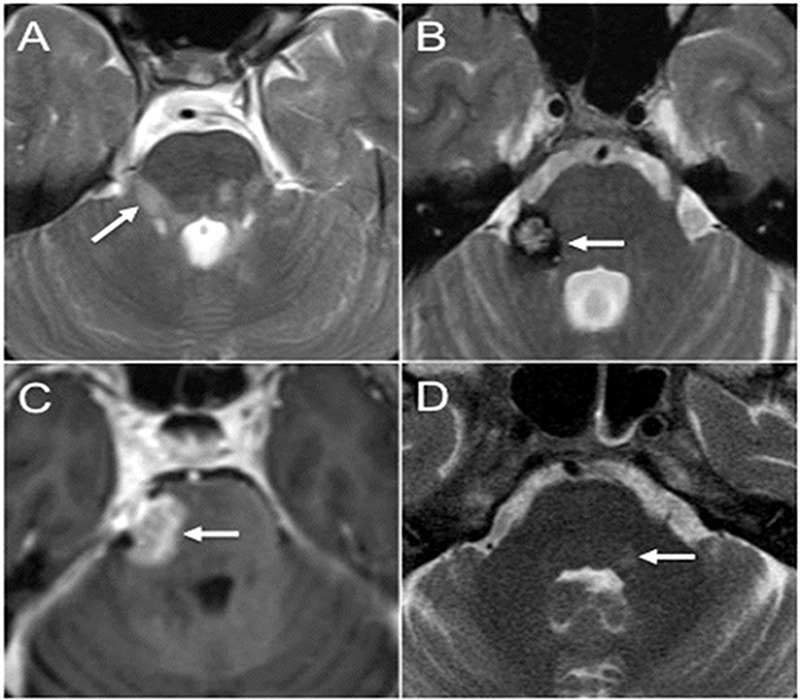 Imaging evaluation of trigeminal neuralgia.