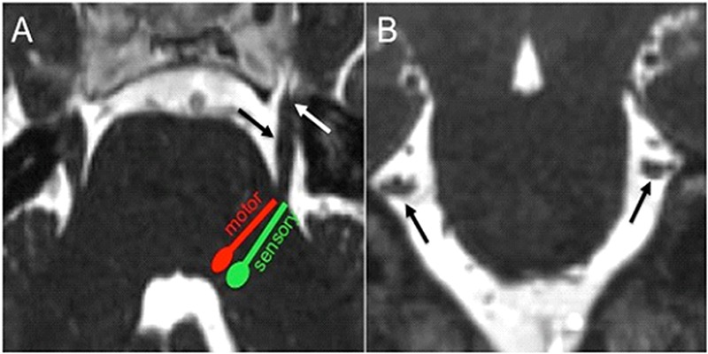 Imaging evaluation of trigeminal neuralgia.