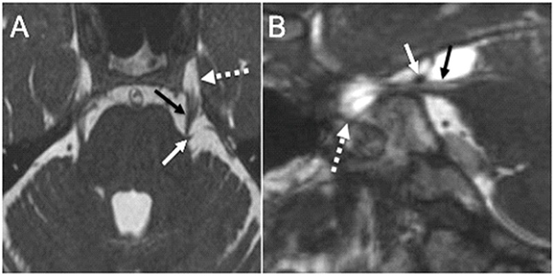 Imaging evaluation of trigeminal neuralgia.