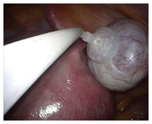 Laparoscopic-extracorporeal surgery performed with a fixation device for adnexal masses complicating pregnancy: Report of two cases.