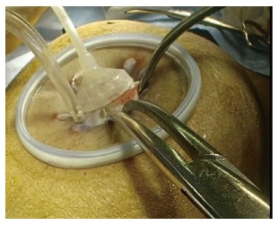 Laparoscopic-extracorporeal surgery performed with a fixation device for adnexal masses complicating pregnancy: Report of two cases.