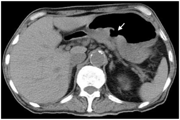 A Case of Gastric Ulcer With Mucosal Bridge.